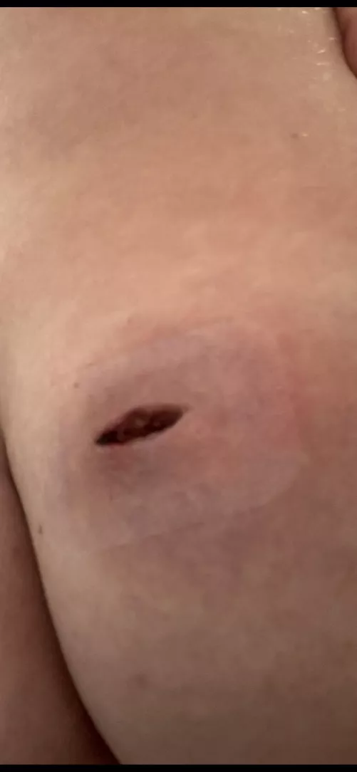 Had an abscess drained two days ago on my butt cheek, prescribed oral antibiotics for 14 days. How long will a wound like this take to close? Not completely healed just closed up