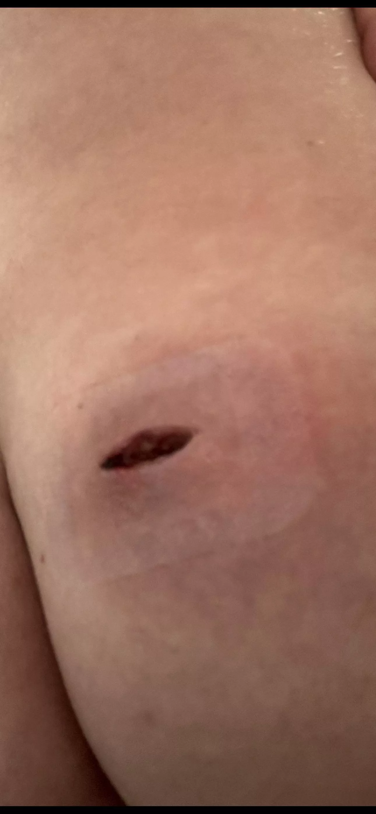 Had an abscess drained two days ago on my butt cheek, prescribed oral antibiotics for 14 days. How long will a wound like this take to close? Not completely healed just closed up