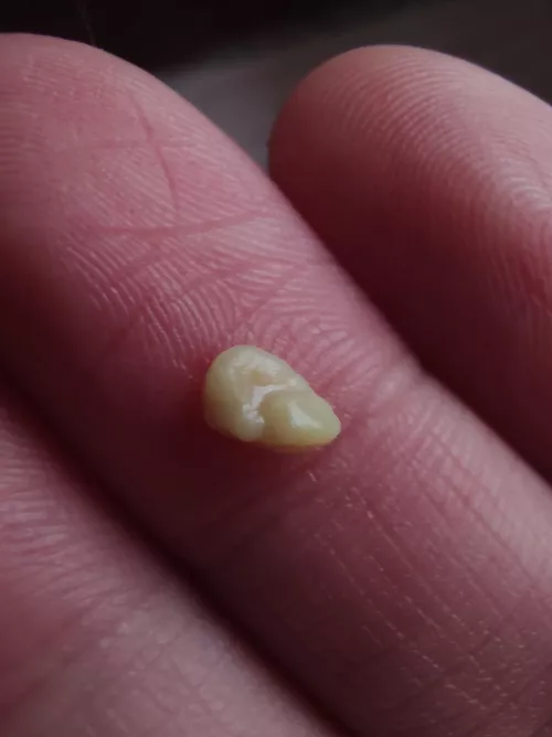 I regularly push out my tonsil stones. This isn't even close to my biggest one. But it was a relief.