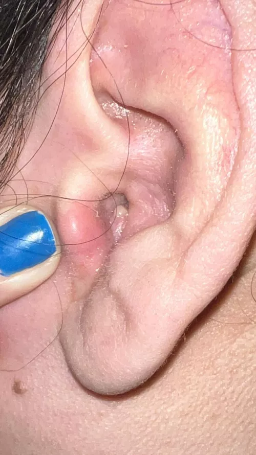 It’s so big I can’t hear! It came out of no where and it hurts so bad I can’t pop