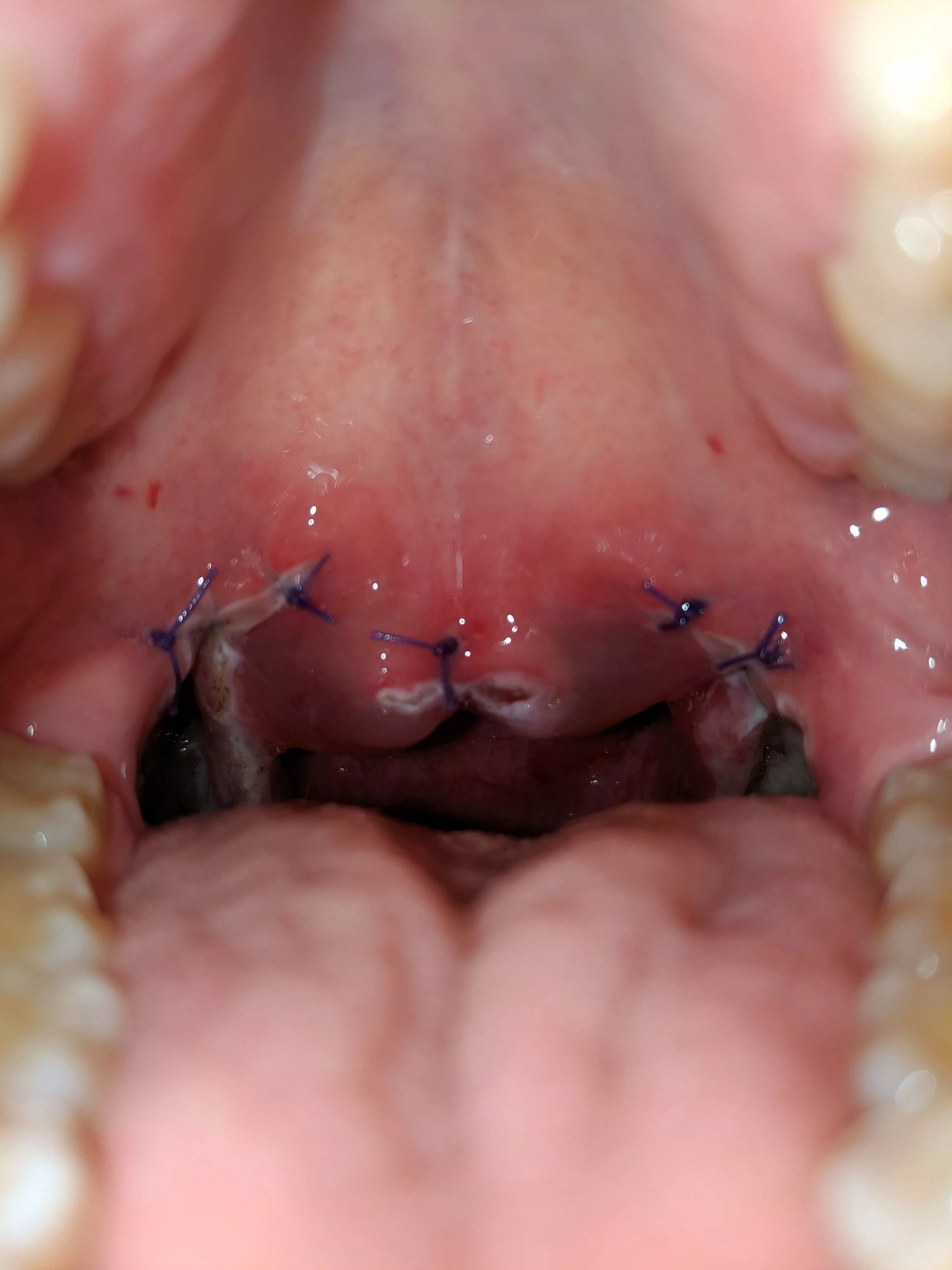 No pop but out of interest to you all on the subject of tonsillectomy