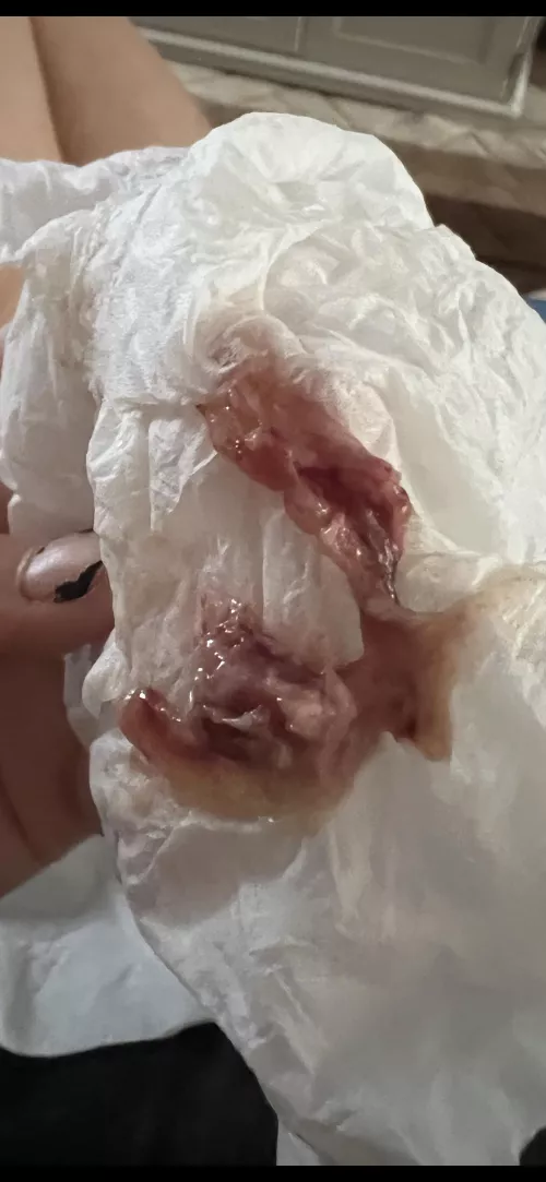 popping related; this came out my nose the other day… does anyone know what this was?