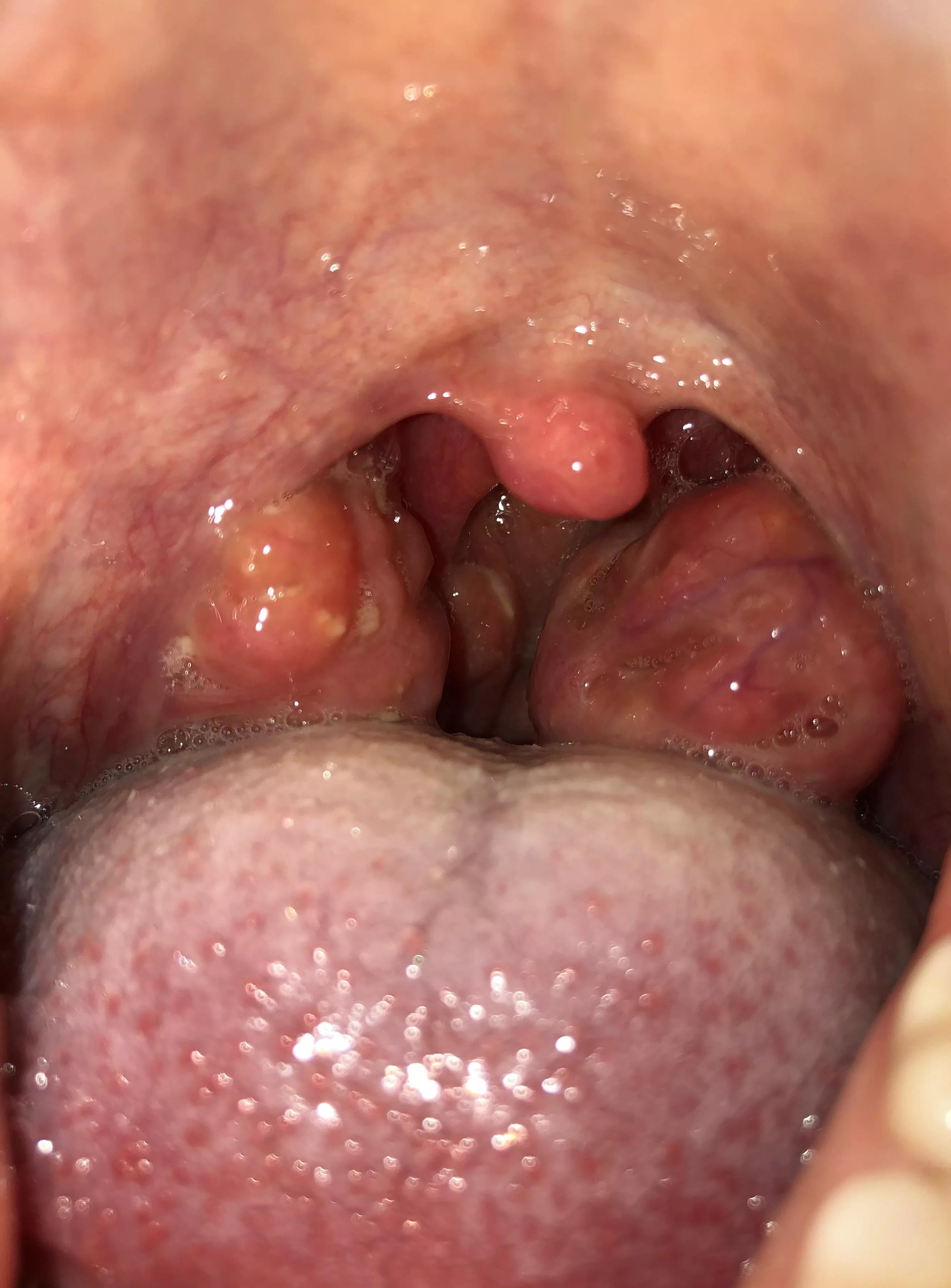 Saw someone post their tonsillectomy recovery results so I got inspired to post a photo of my tonsils before I got my tonsillectomy lol