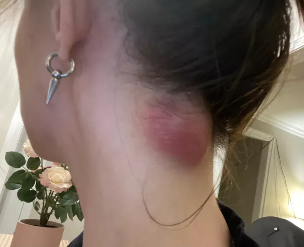 [Cyst] Has anyone ever had anything like this? I have surgery scheduled in 10 days, waiting feels unbearable. Diagnosed as an epidermoid cyst. Present for almost 2 months, absolutely huge and chronically inflamed/painful. Sticks out of my neck like a ten