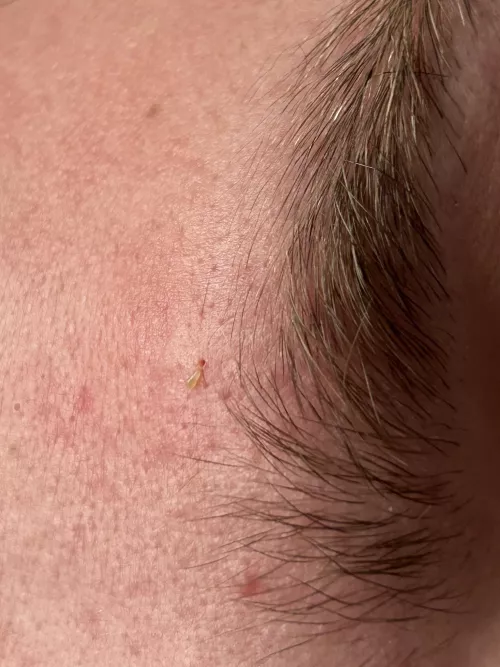 Little blackhead above my friends brow and the hole it left