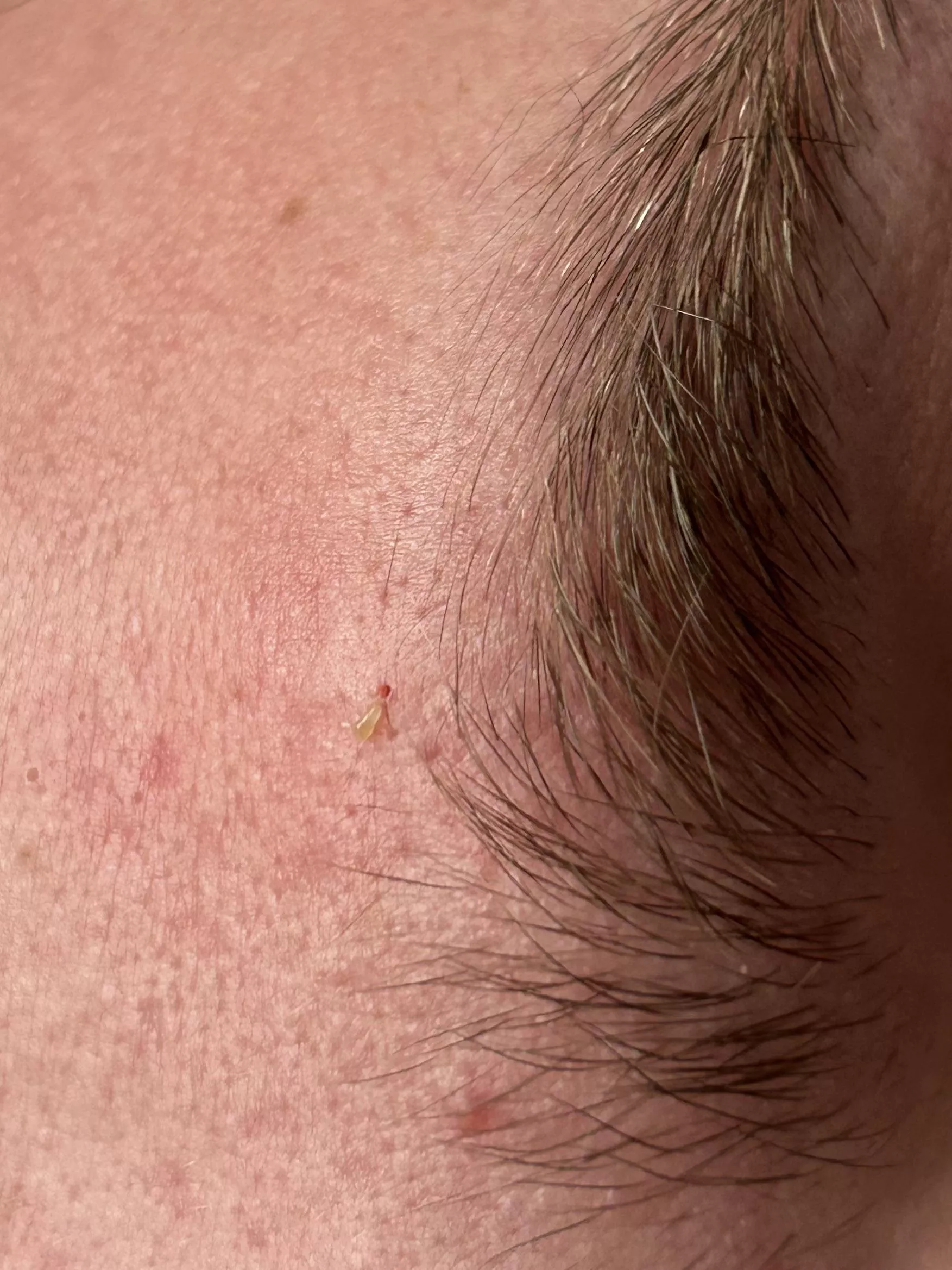 Little blackhead above my friends brow and the hole it left