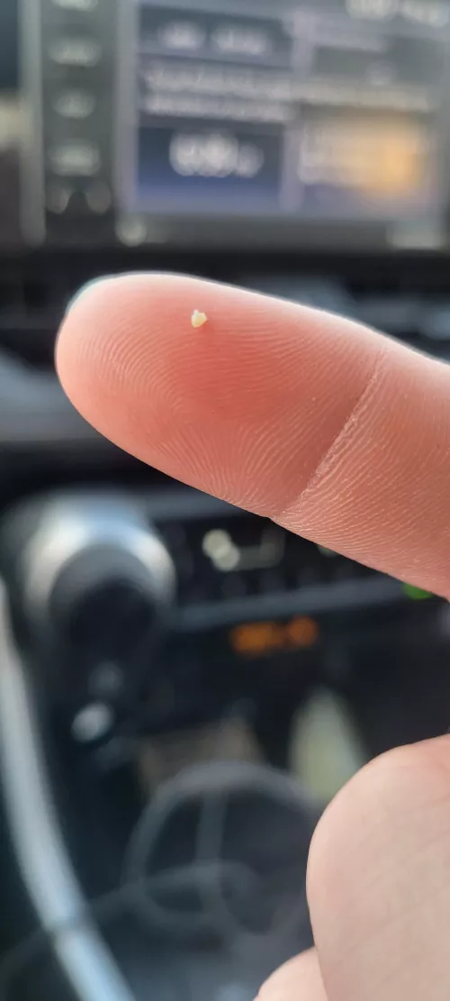 I get a milia-on of these on my face, since I have psoriasis. Annoys me but they're very satisfying to extract!