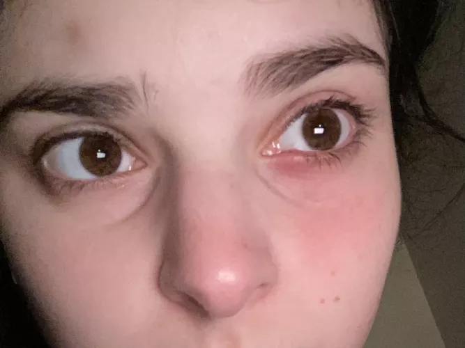 Some time and some hot compresses later. I am in hell