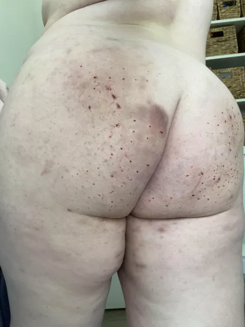 Bruises are my favorite🖤