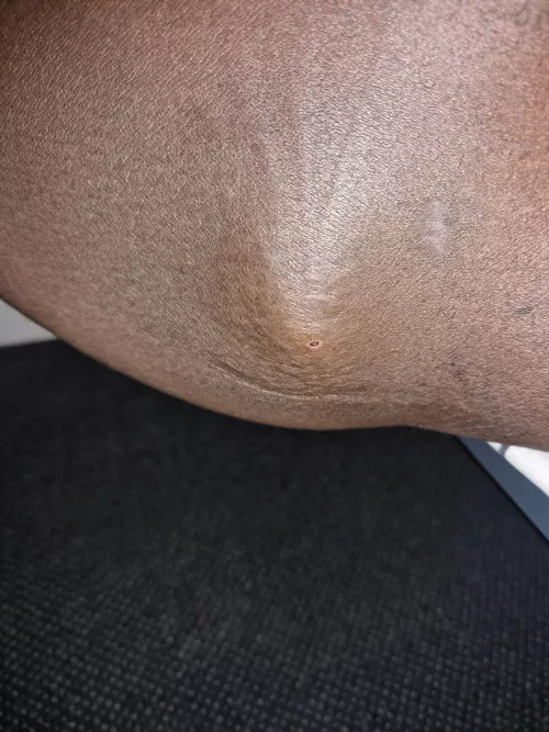 Stiff, hard and painful. Feels like an egg in my thigh. Can't walk without pain. What could it be and what to do