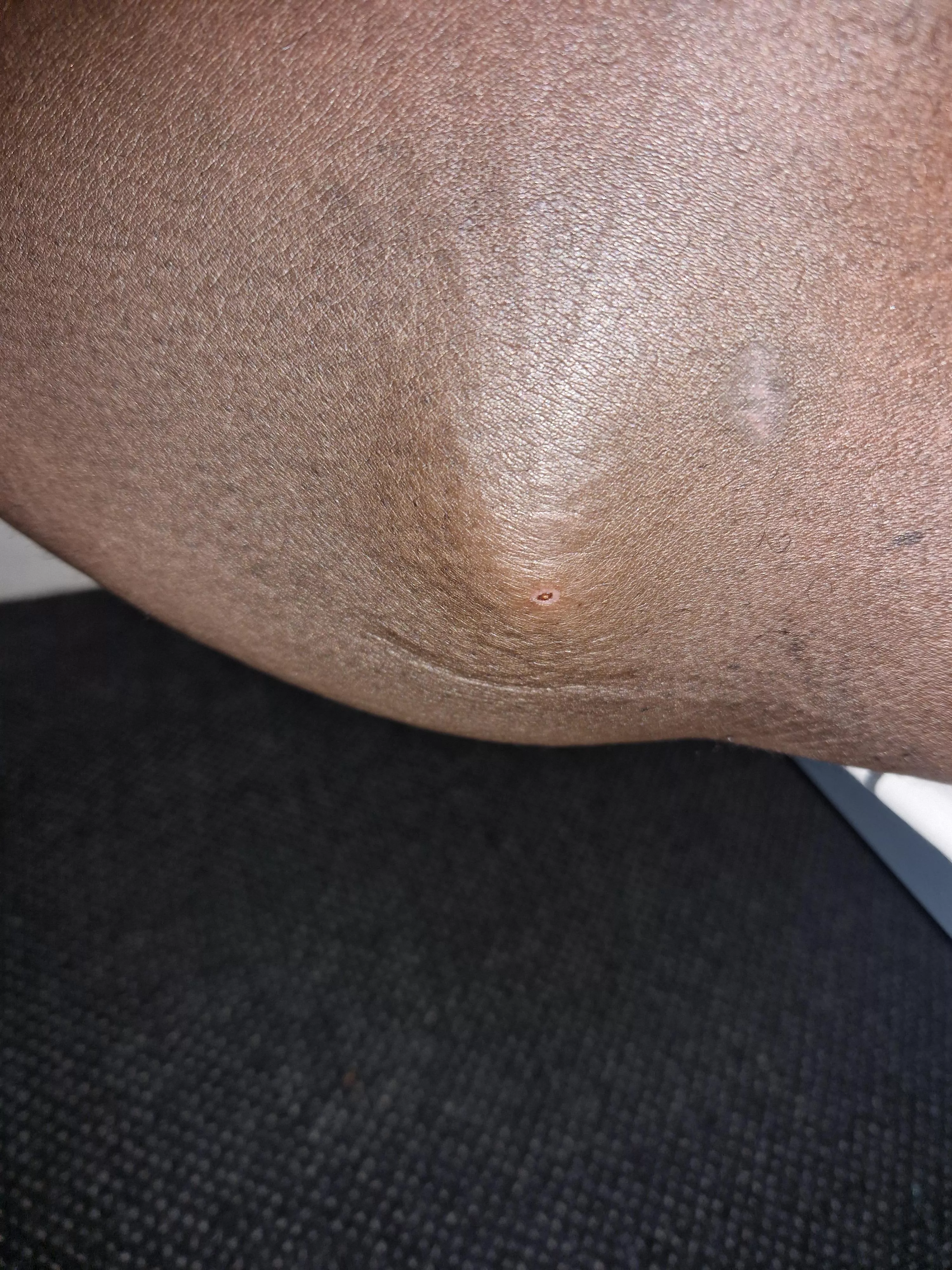 Stiff, hard and painful. Feels like an egg in my thigh. Can't walk without pain. What could it be and what to do