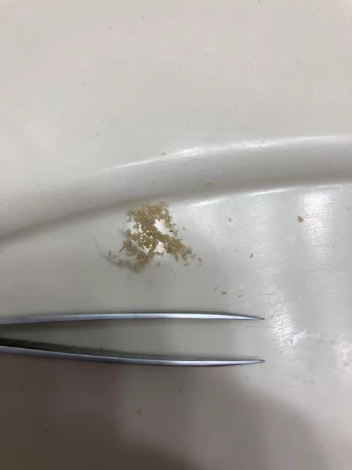 I don’t know what else to do with this picture. All of the blackheads I squeezed out of my nose in about 2 hours.