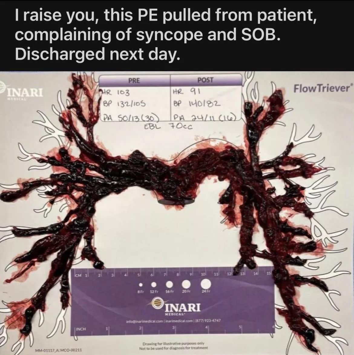 Look at this size of this lung clot! Imagine how much better you’d feel after it was out!