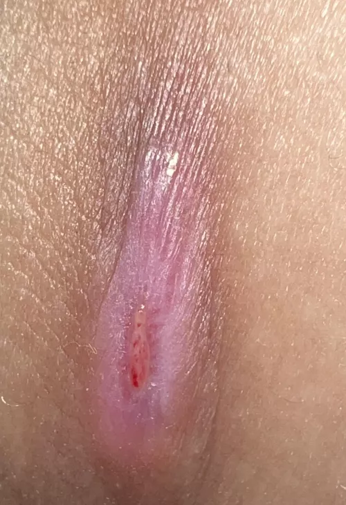Anyone know what type of cyst this is? It’s near the upper thigh area and has already popped several times. (It popped recently and still hasn’t healed)