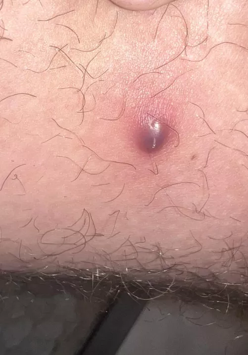 Dark purple Boil on inner thigh