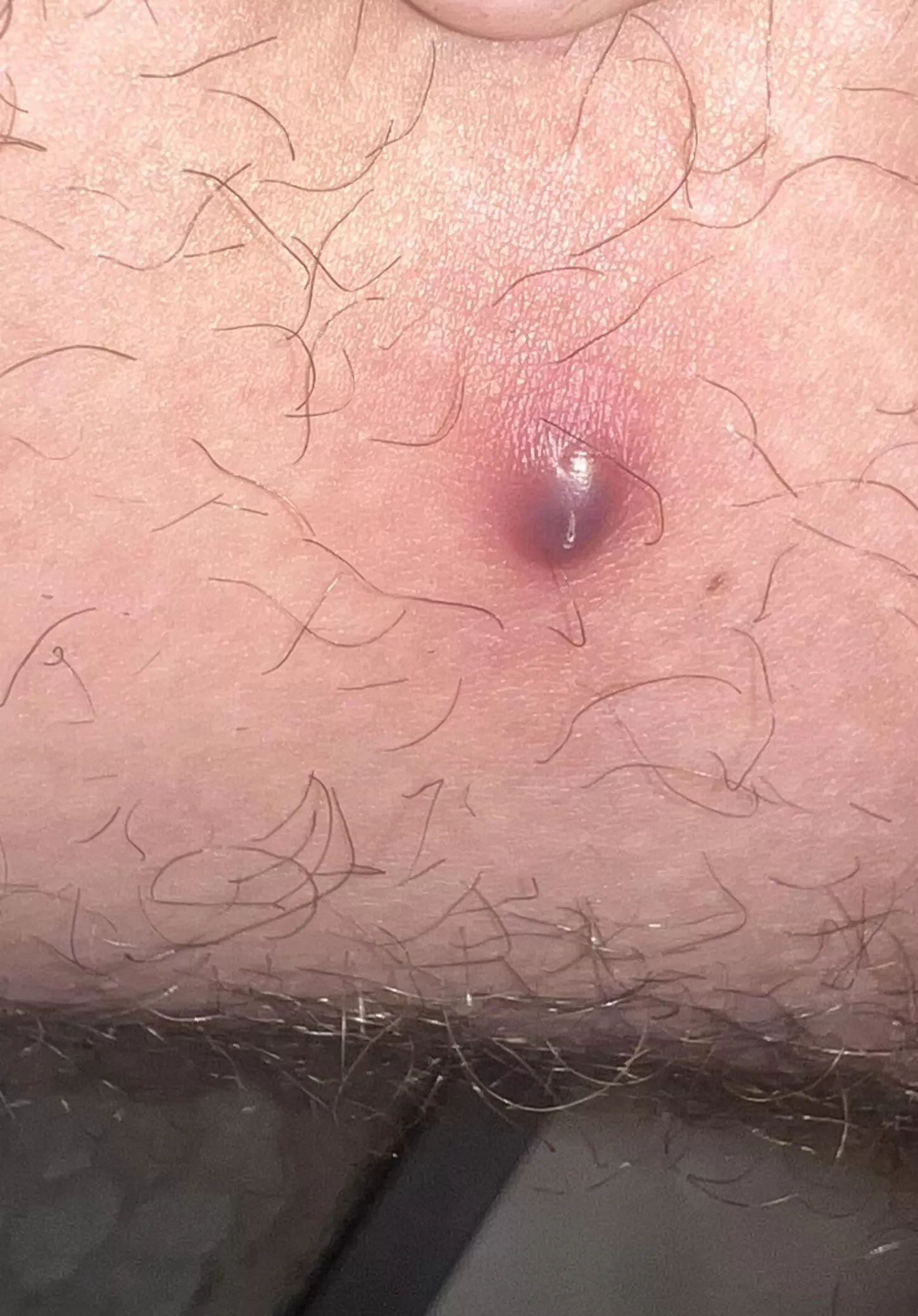 Dark purple Boil on inner thigh