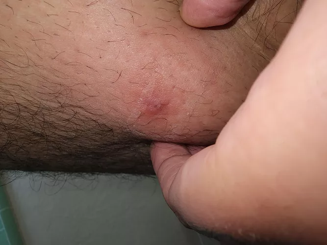 Ingrown hair l? It came to a slight head but I drained it a bit.