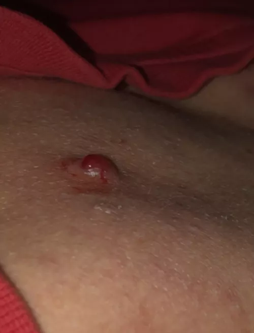 Its been weeks since I last picked it. Picked the crust and now its bleeding badly… Im thinking it may never go😬