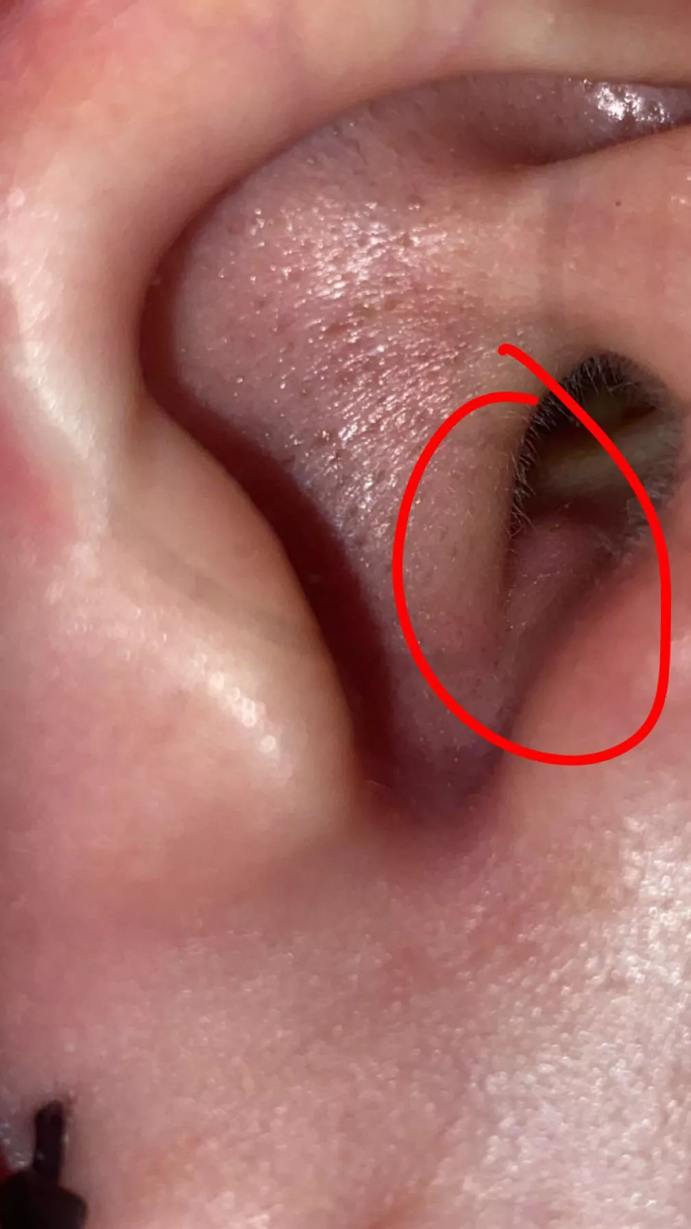 i have this blackhead pimple type thing in my ear and it hurts so bad, i tried to pop it a couple times but i’m gonna just leave it and keep applying warm compress now cuz it hurts too bad lol