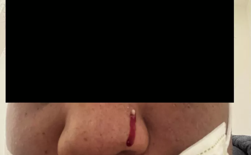 One of the worst pops I’ve had in my life. It hurt so bad before and hurt bad when I popped it. It hit the mirror too and bled bad after. Never had a pimple this bad before in my 28 years of living.
