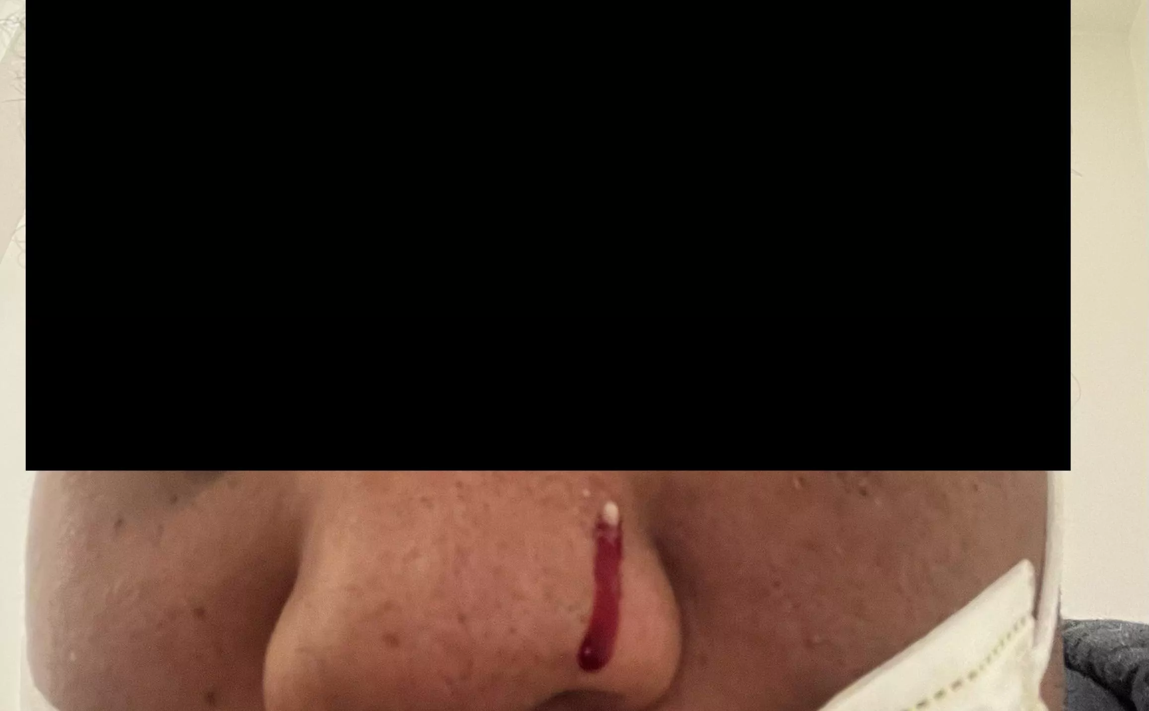 One of the worst pops I’ve had in my life. It hurt so bad before and hurt bad when I popped it. It hit the mirror too and bled bad after. Never had a pimple this bad before in my 28 years of living.