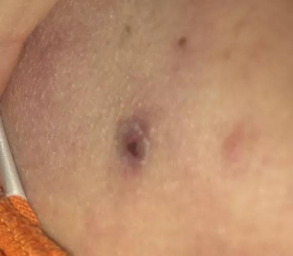 Should I get it looked at? It used to be a bleeding cyst.