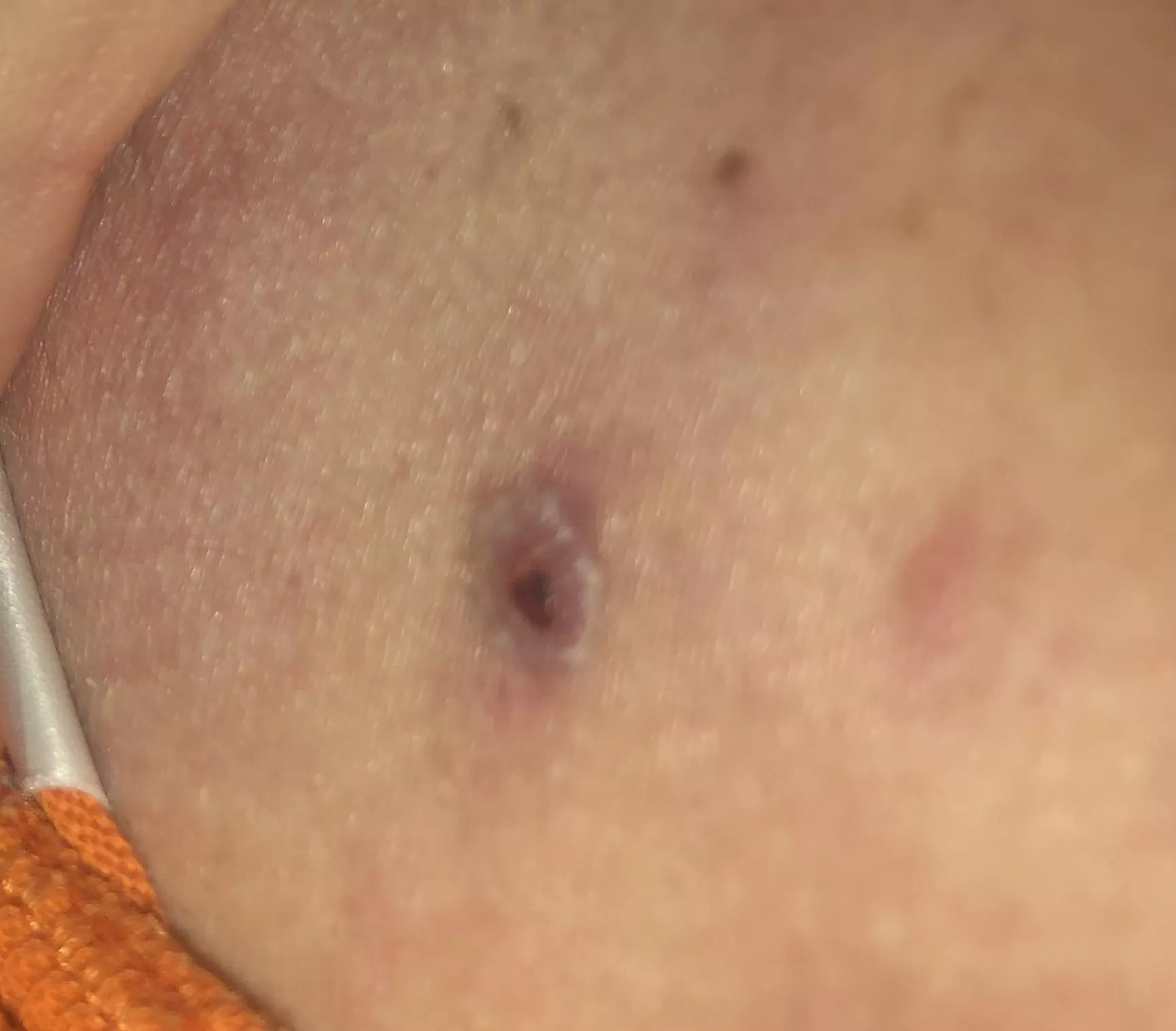 Should I get it looked at? It used to be a bleeding cyst.