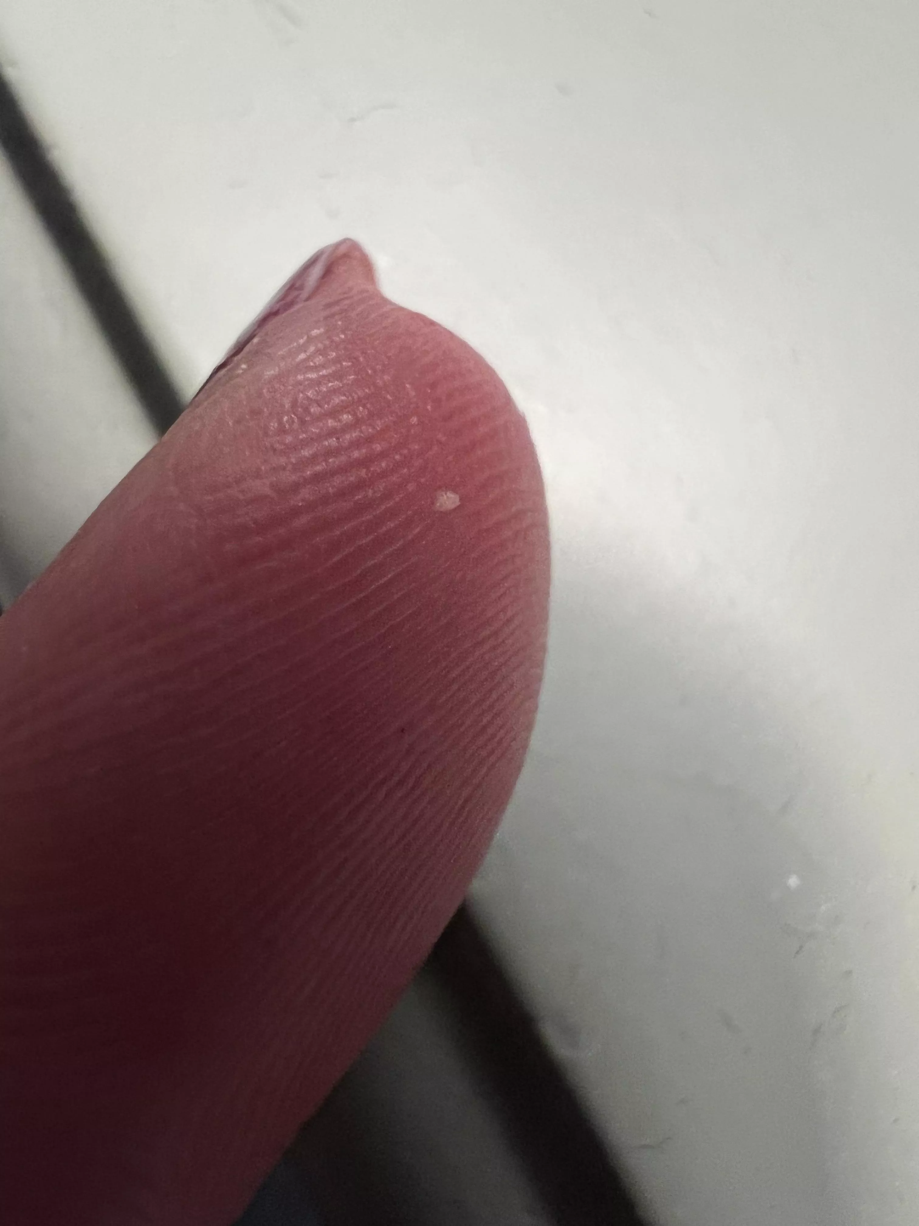 milia from forehead finally cut it out!