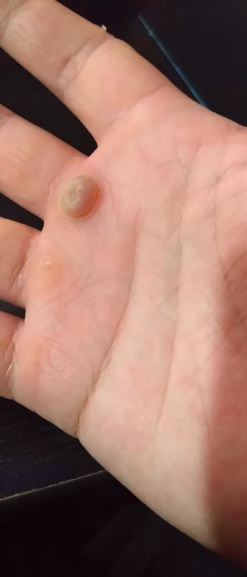 Taking all my willpower not to pop this little fucker