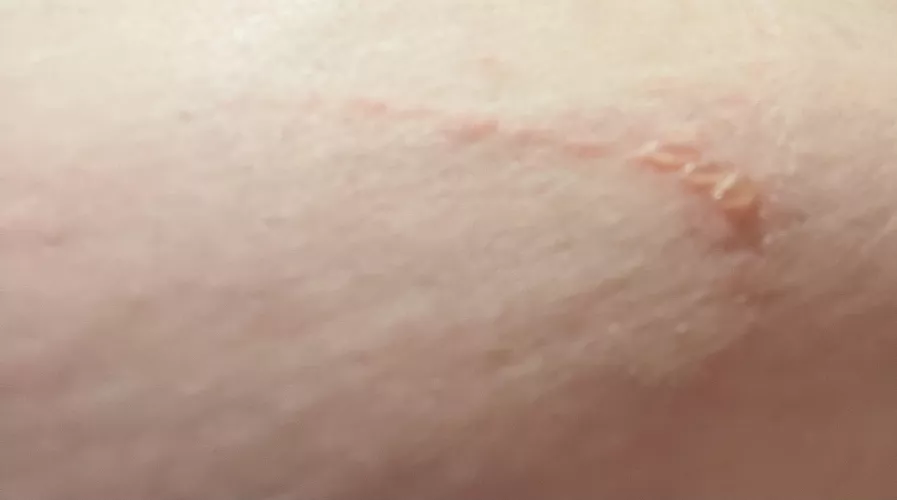 Forbidden pops from KT tape.