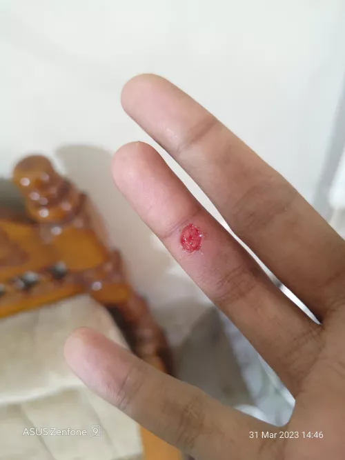 Wart that has been bothering me for more than year, Finally decided to see cosmetic dermatologist and cleared it using co2 laser treatment