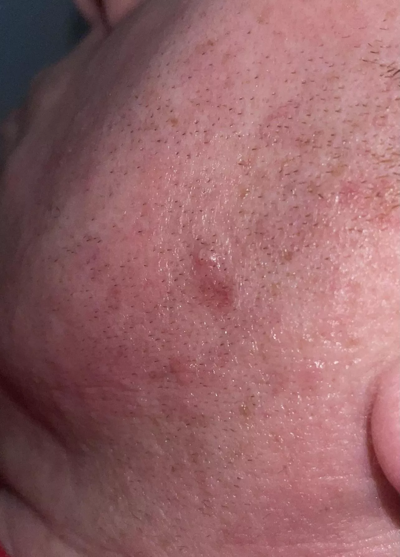 Could this be an ingrown hair?