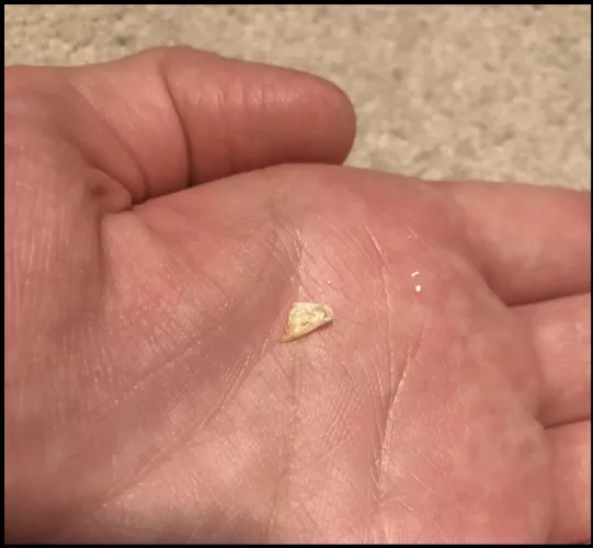 Ear felt blocked. Doctor checked and assured me no wax blockage. At home this chunk of dry skin fell out.