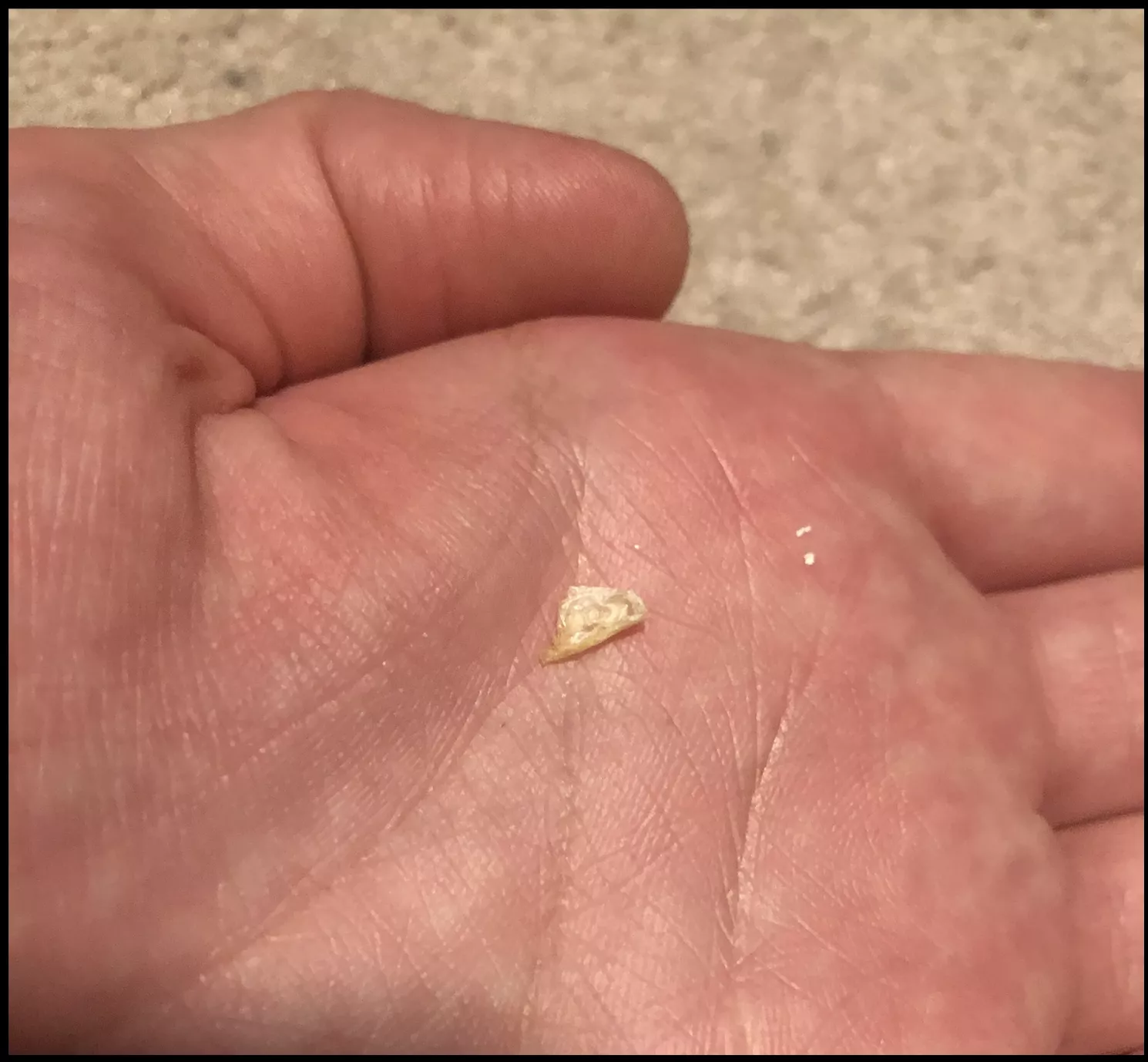 Ear felt blocked. Doctor checked and assured me no wax blockage. At home this chunk of dry skin fell out.