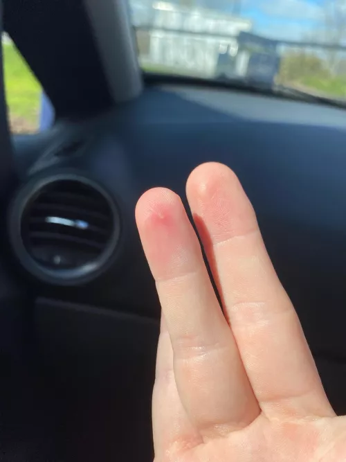 What is this little white spot on my finger? Stingy when touched doesn’t feel like a splinter