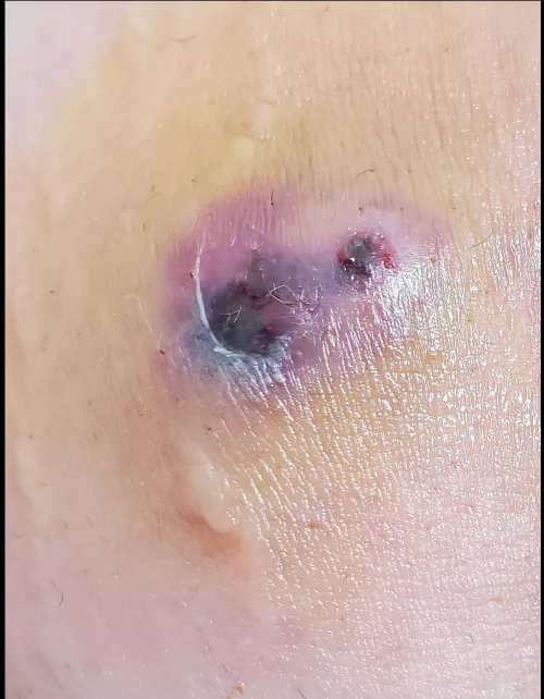 Angry abscess on my inner thigh. Size of an egg.