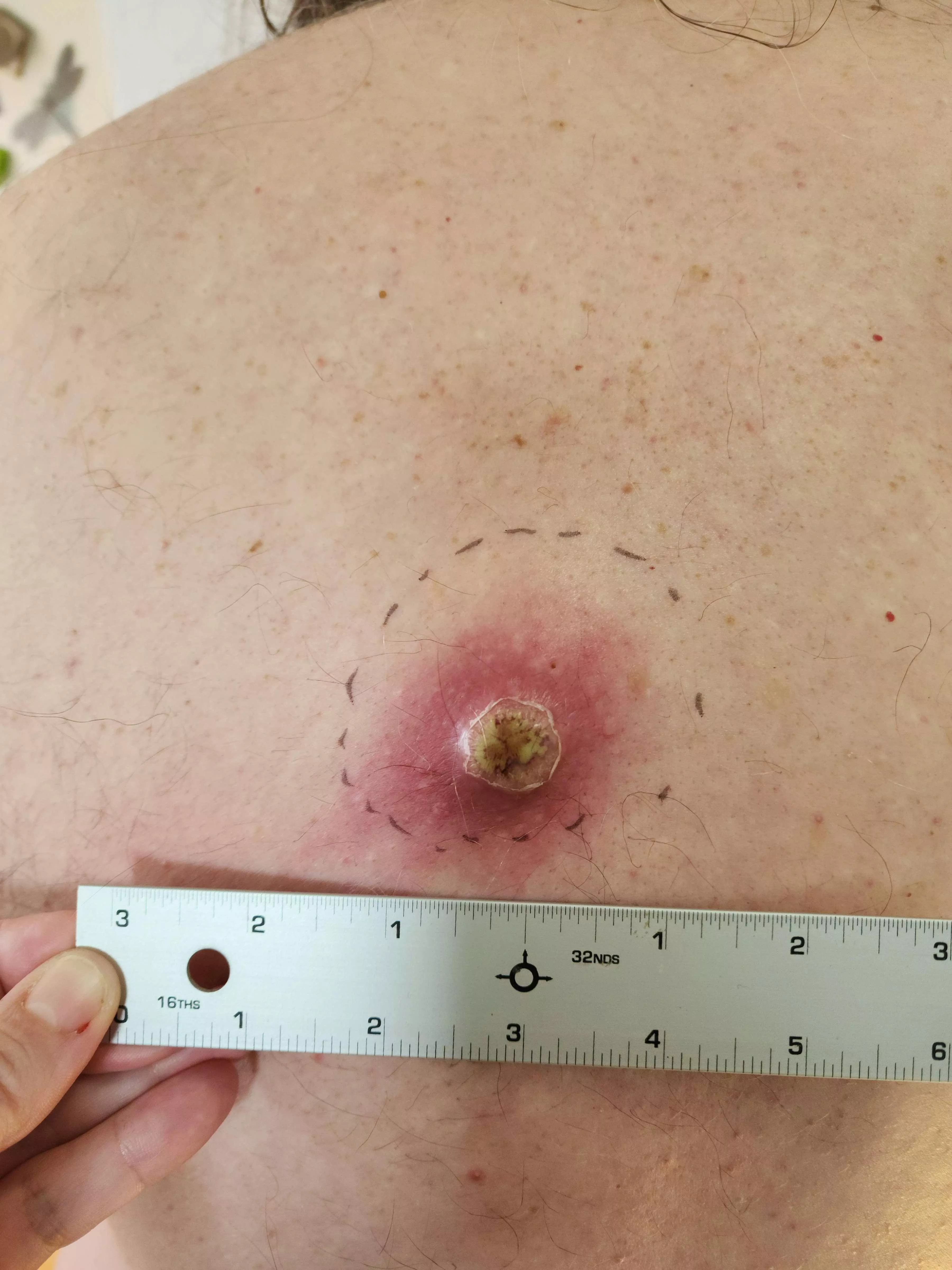Preview - Angry Back Cyst