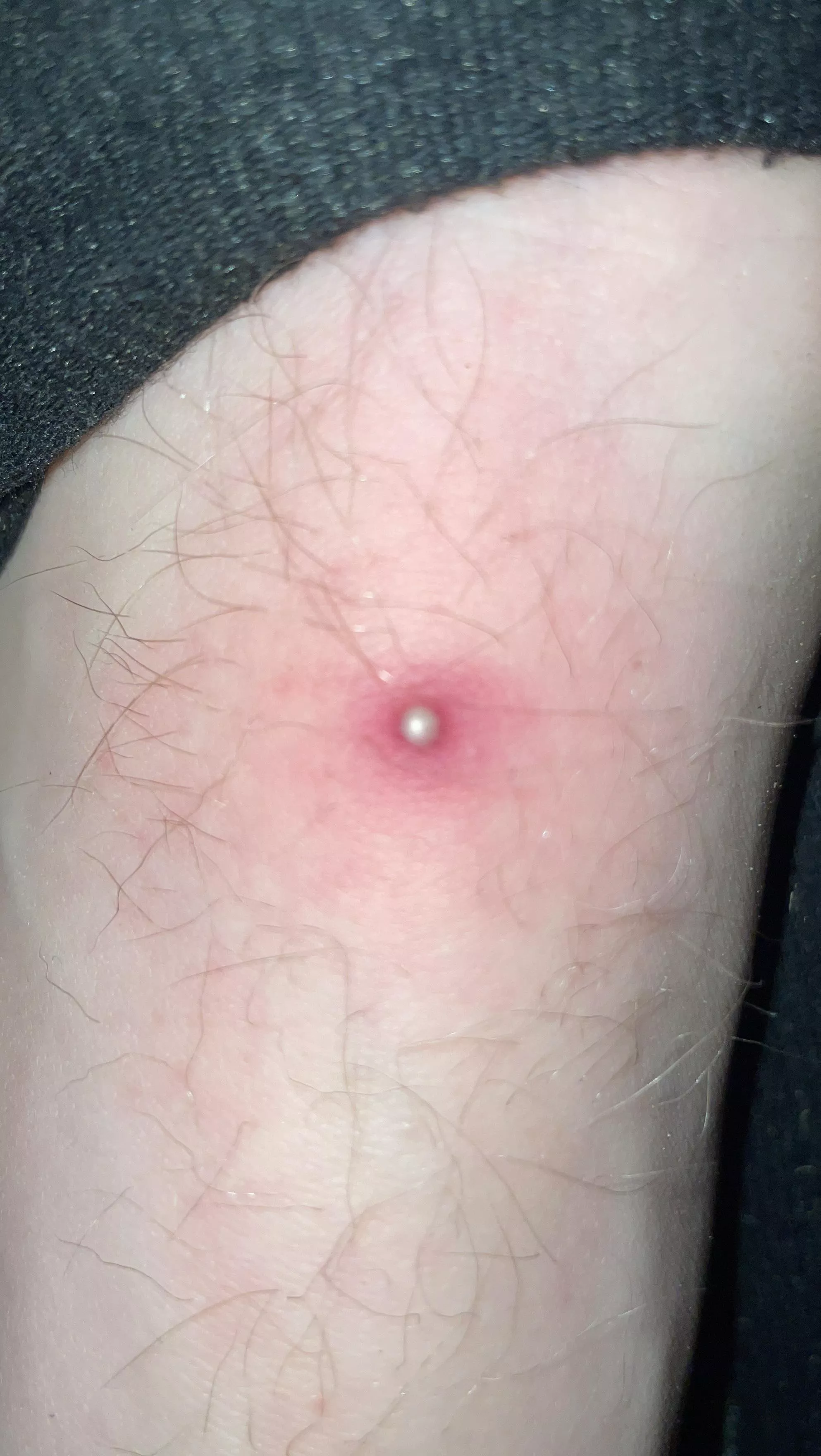 Can this be popped? And what is it exactly? I can barely put on my shoe, hurts a lot when touched.