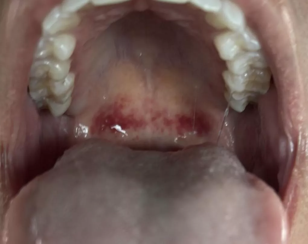 Throat after oral