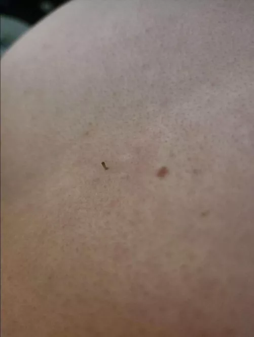 I haven't cleared out my boyfriend's back for a long time and today I found the mother of blackheads (girth not length)