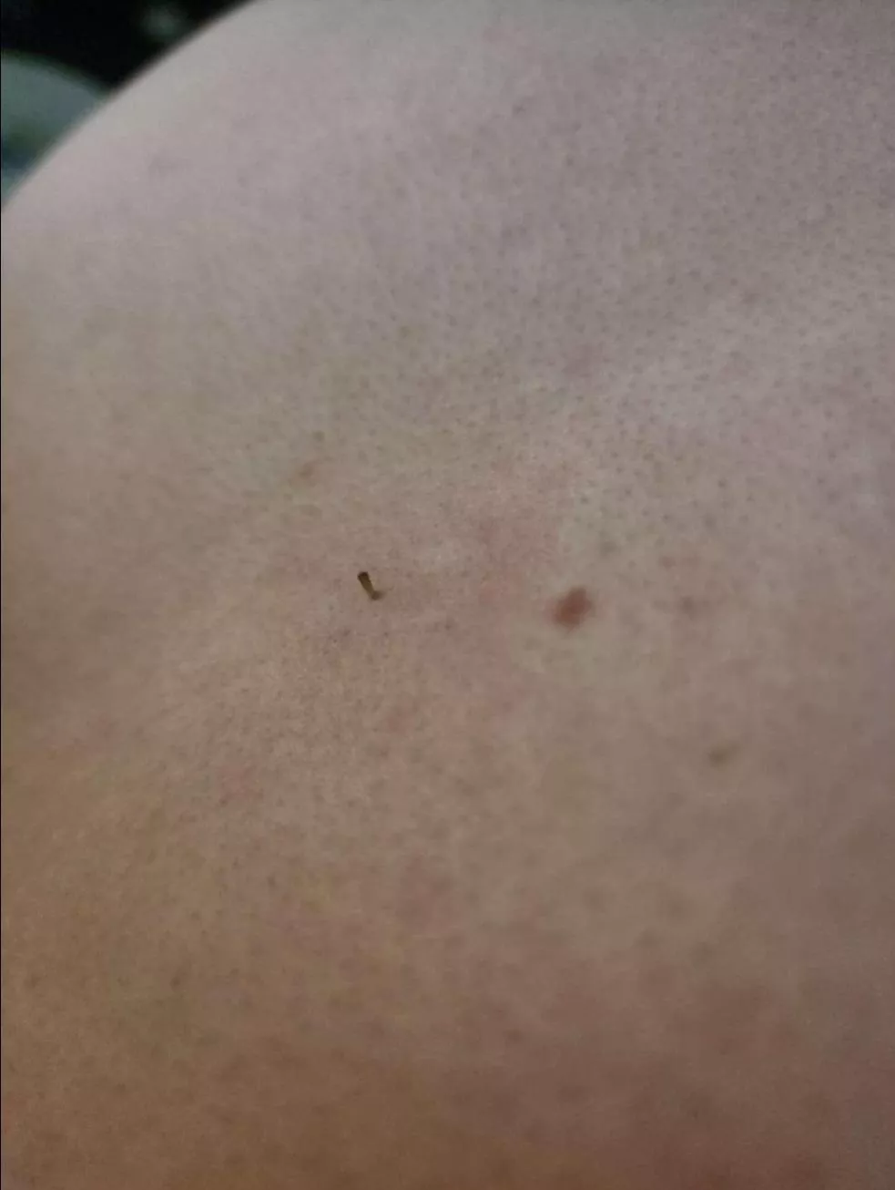 I haven't cleared out my boyfriend's back for a long time and today I found the mother of blackheads (girth not length)