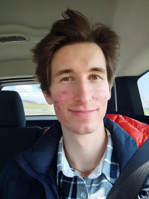 Happy Easter Monday 💙 2 months on acne treatment and it keeps getting better