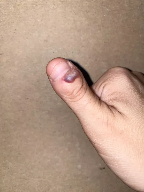 It’s my Megan Fox thumb, she has so many struggles. Finally let a Dr do the freeze today. Must.. not.. pop….