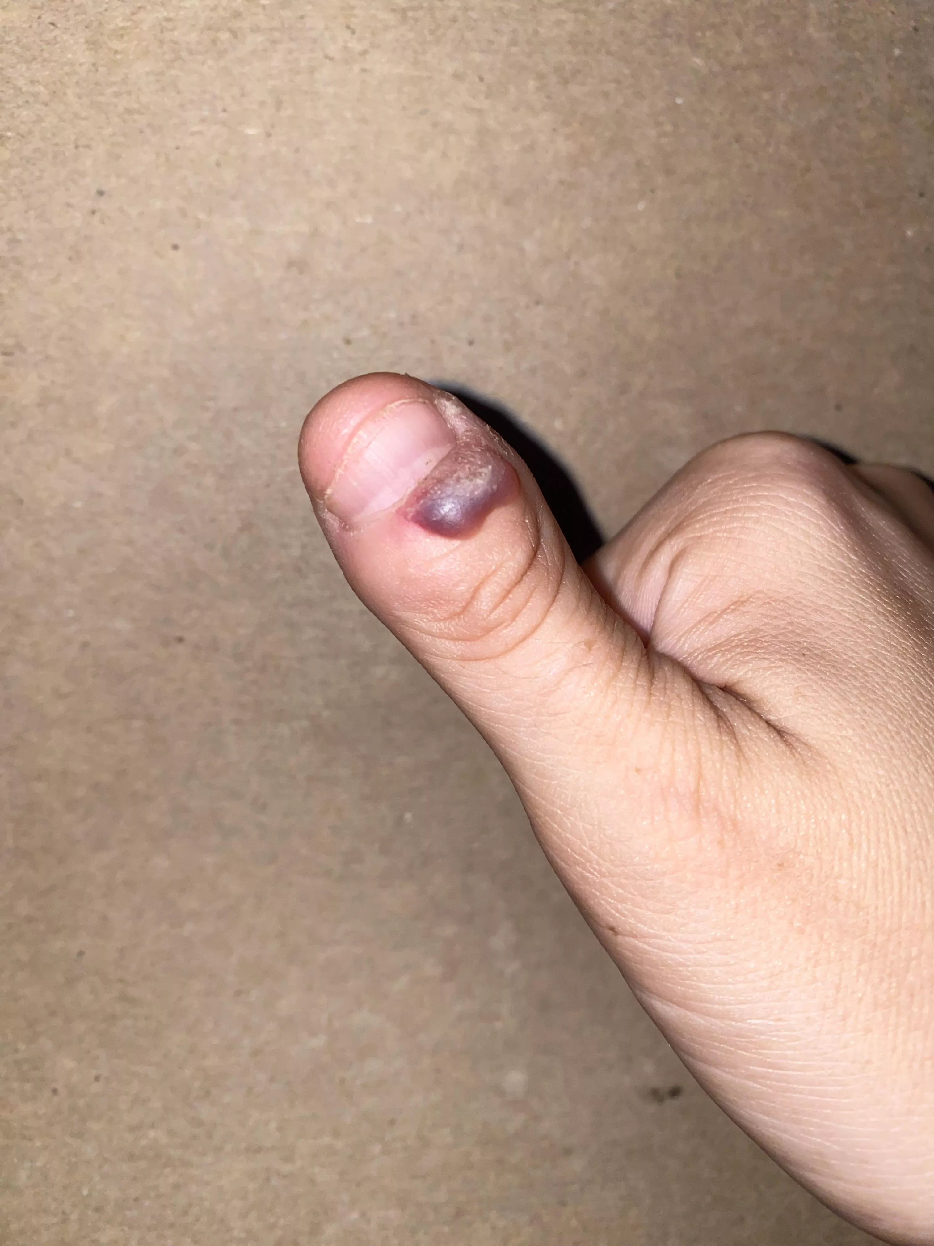 It’s my Megan Fox thumb, she has so many struggles. Finally let a Dr do the freeze today. Must.. not.. pop….