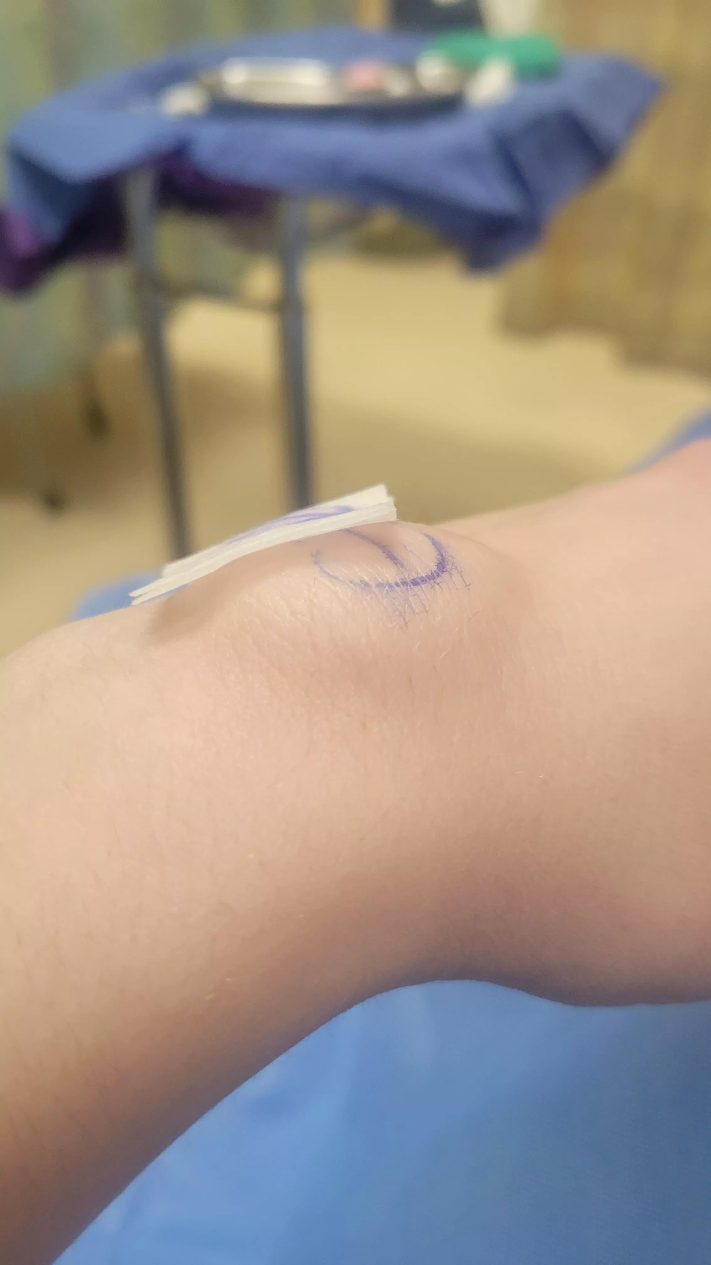 The surgeon numbed my wrist for a cyst removal and the freezing created a huge bubble under my skin.