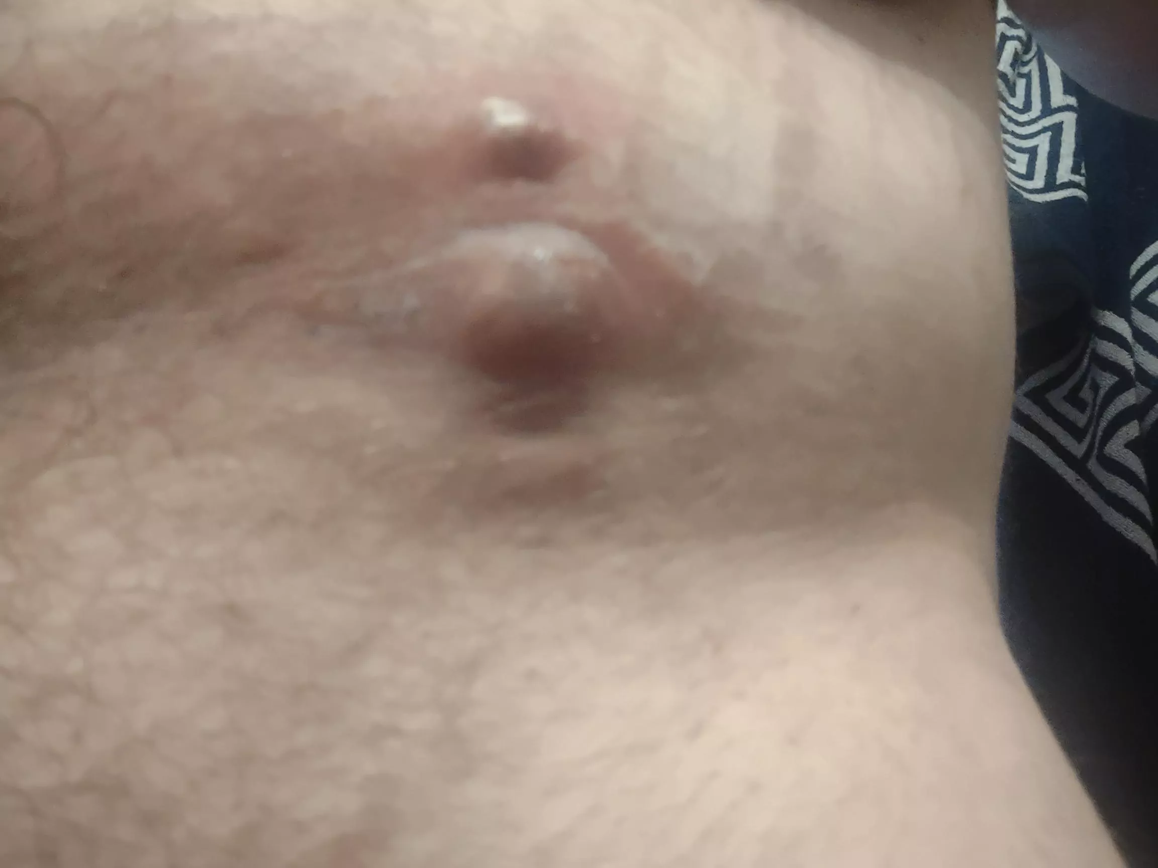 Thinking about lancing this on my waist.