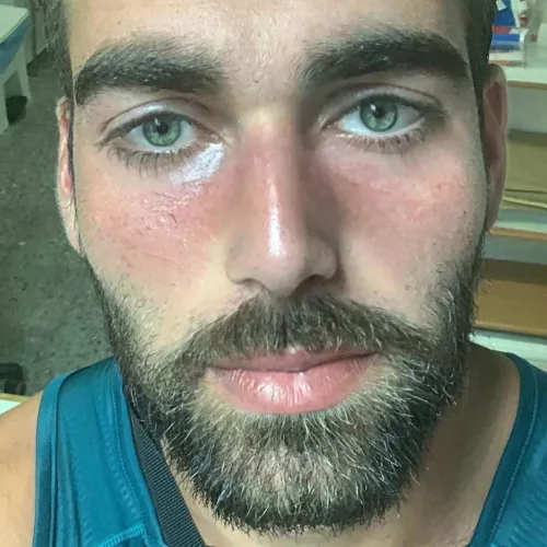 Rosacea flare-up. I struggled with this for years and am still struggling.