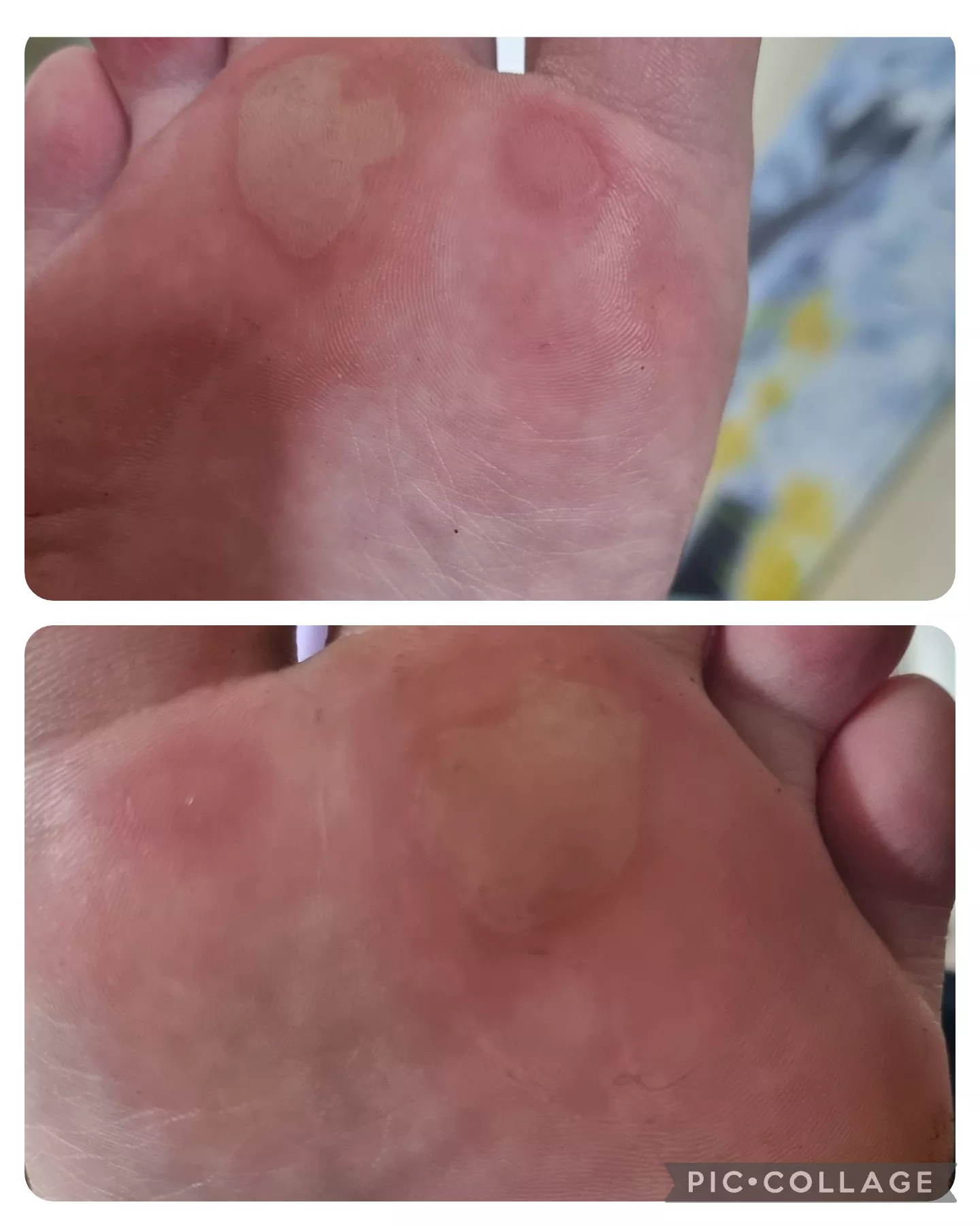 Went for a long walk in sandals the other day at 33 weeks pregnant, like a fool. Now I have these fun blisters