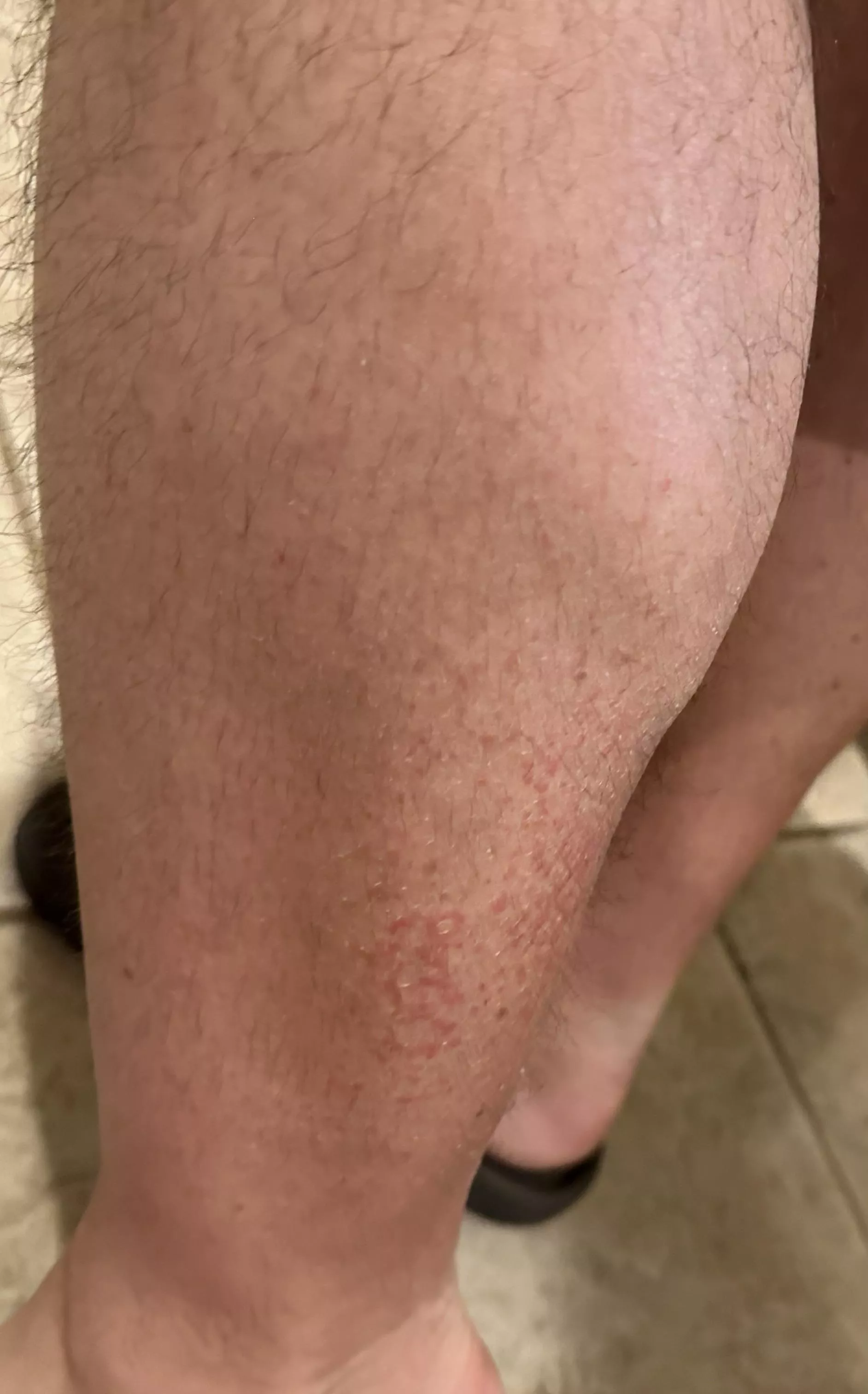 What I thought was eczema is actually cellulitis, so no popping or scratching