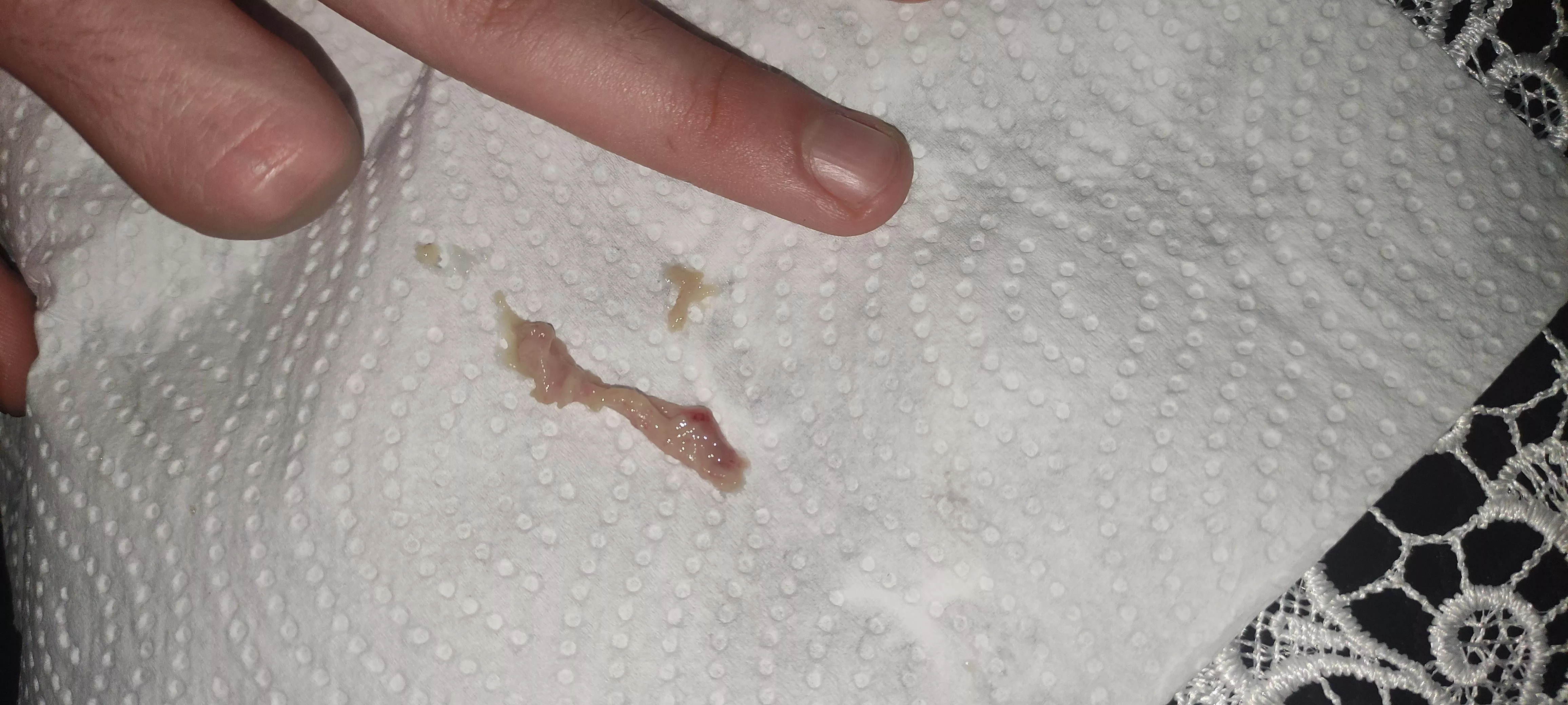 What even is this thing that came out of my nose (41° fever)
